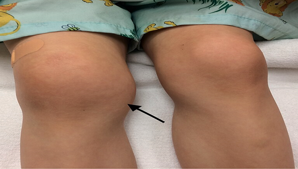 Figure 2: Lyme Arthritis from Lyme Disease. This Image is Licensed under Creative Commons Attribution.