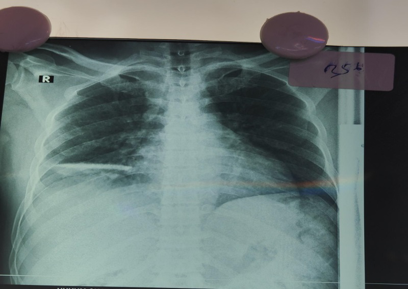 Figure 1: X-Ray Chest showing knife blade in right lung.