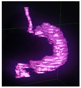 Figure 1: 3D reconstruction model of the stomach of a non- operated patient.
