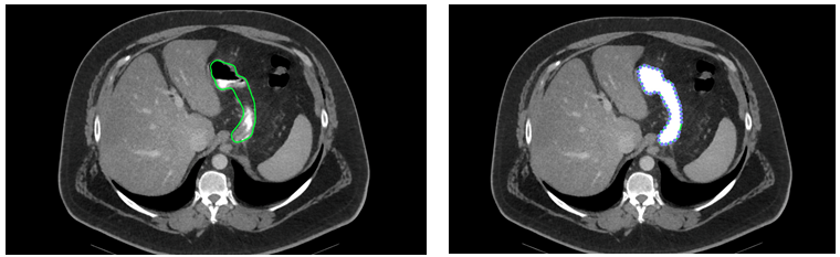 Figure 2: manual segmentation and density change of the stomach surface in CT slices.