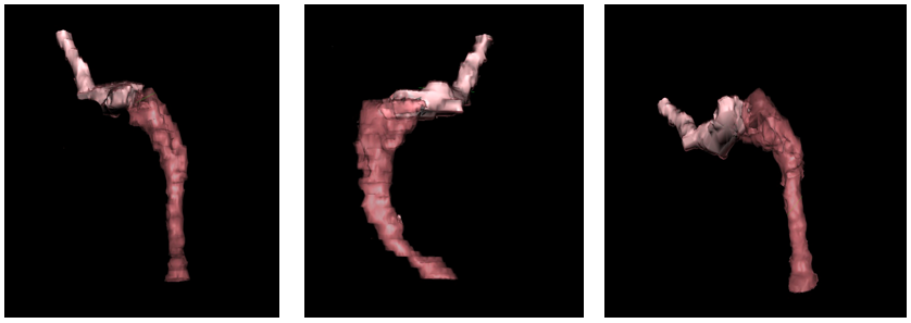 Figure 5: Case 3: model of laparoscopic gastric bypass gastrojejunostomy with clinical evidence of stenosis.
