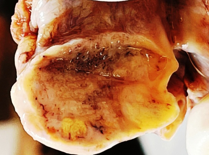 Figure 1: Right ovary shows well-circumscribed tumor with a smooth lobulated outer surface, homogenous, solid, firm, tan- yellowish on cut surface.