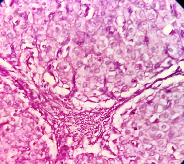 Figure 3: The neoplatic cells are of uniform round with abundant eosinophilic cytoplasm. The nuclei are round, uniform, having prominent central nucleoli (hematoxylin and eosin staining, magnification ×400).