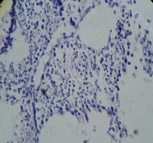 Figure 2: Degradation of seminiferous tubule, scattering of spermatogonia seen.
