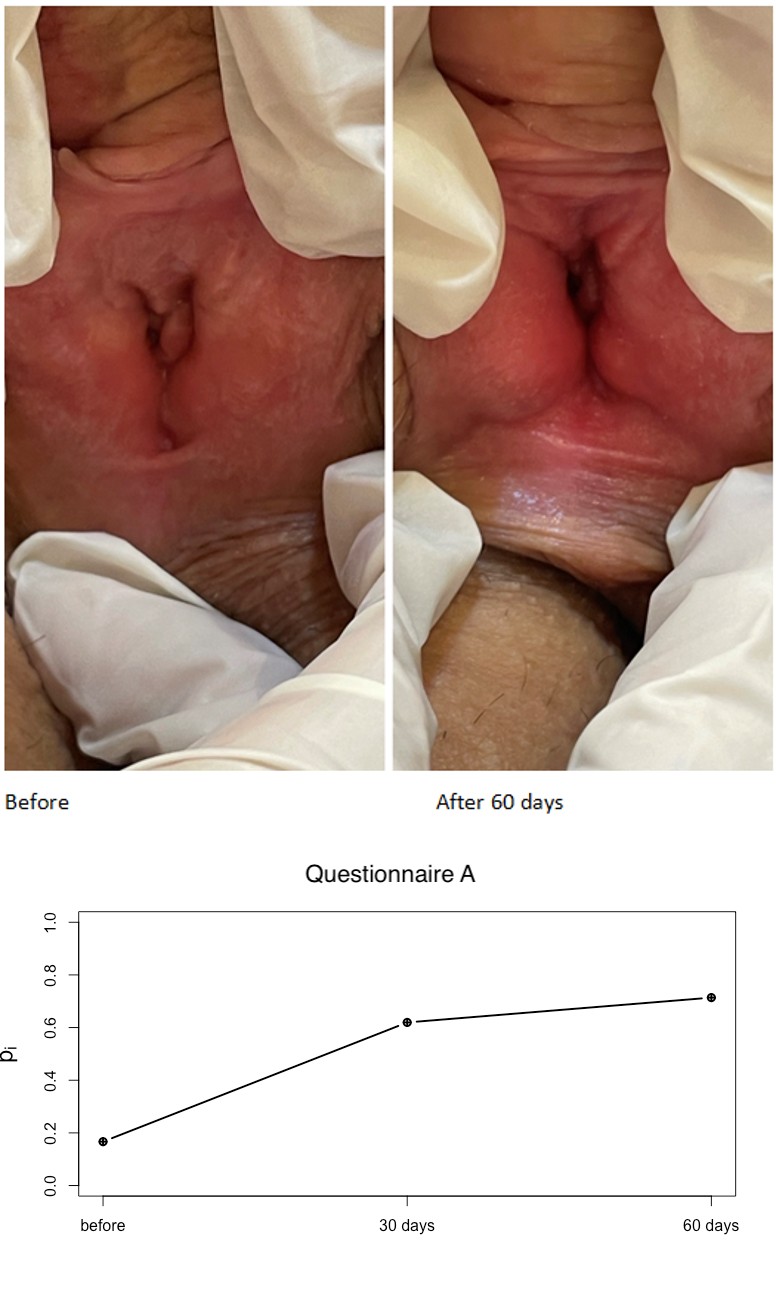 Figure 4: Vaginal mucosa visually less atrophic 60 days after injection.