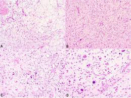 Figure 1: Myxoid pleomorphic liposarcoma delineating aggregates of spindle shaped cells permeated with inconspicuous cytoplasm and ovoid hyperchromatic nuclei. Surrounding pool of myxoid substance is imbued with abundant, ramified capillaries [6].