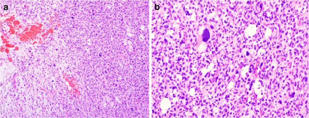 Figure 2: Myxoid pleomorphic liposarcoma demonstrating clusters of spindle shaped cells incorporated with inconspicuous cytoplasm and oval, hyperchromatic nuclei. Circumscribing pools of myxoid substance are pervaded with focal haemorrhage and abundant, branching capillaries [7].