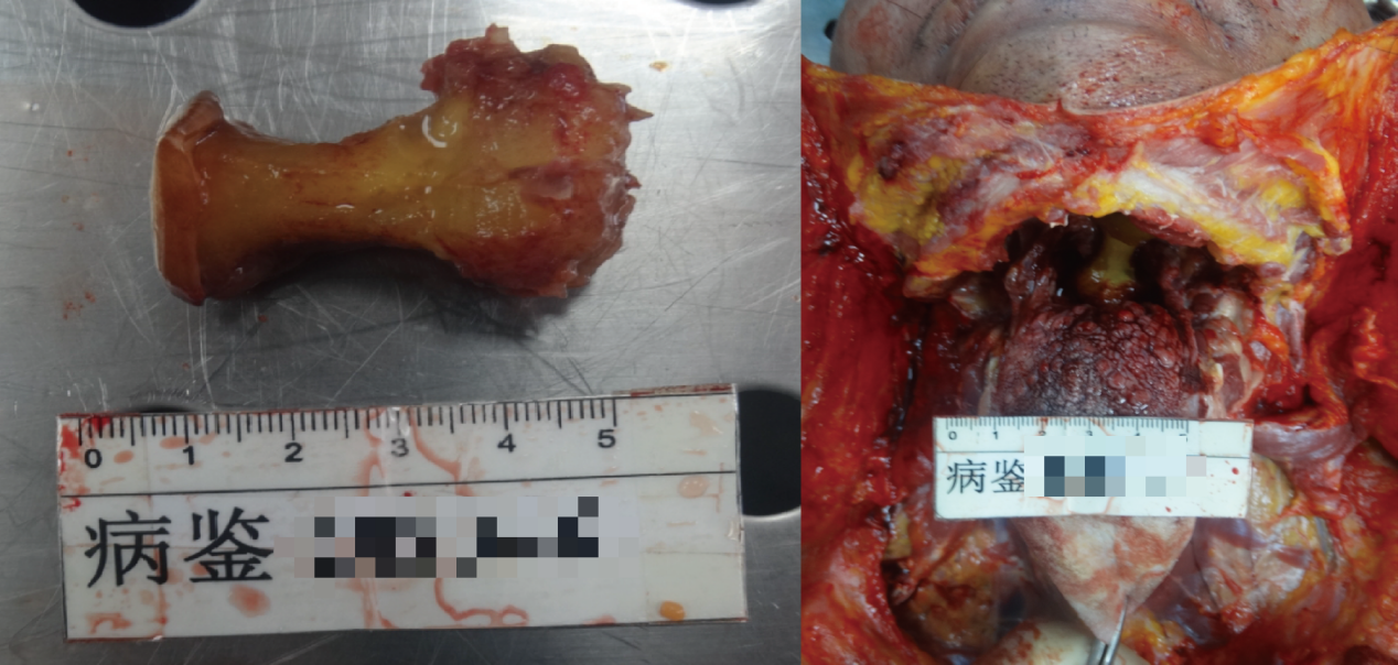 Figure 1: The Apple Core above the Throat.