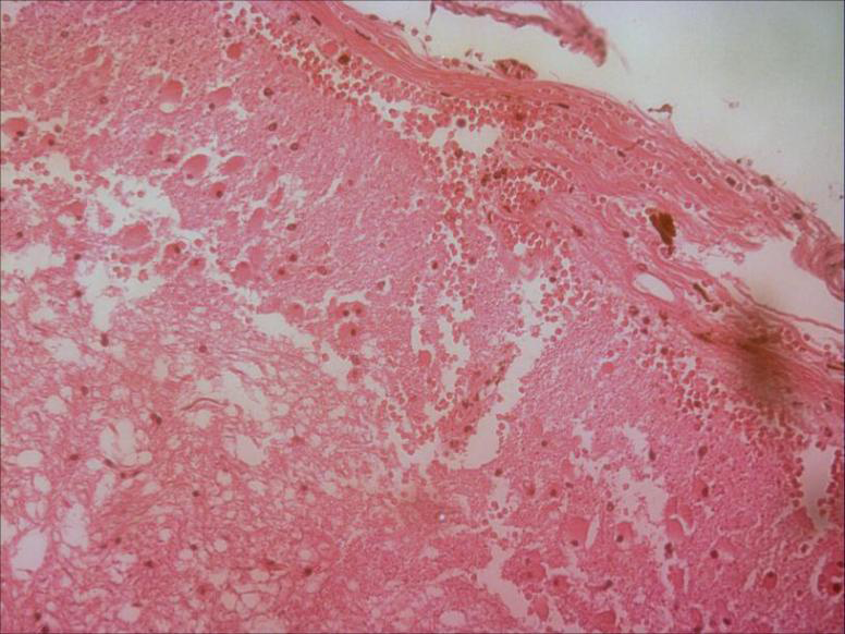 Figure 3: Slit Contusion Bleeding in Regional Tissue of Pons.