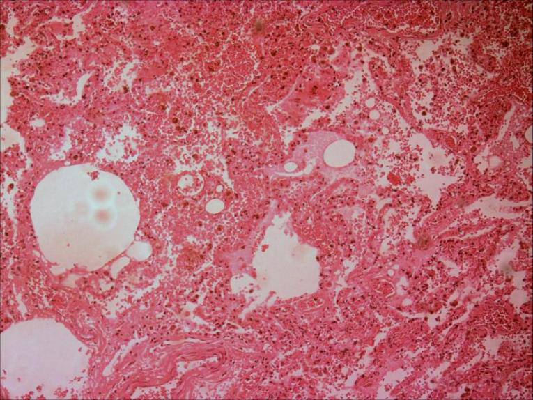 Figure 4: Pulmonary Edema and Passive Congestion of Lungs.