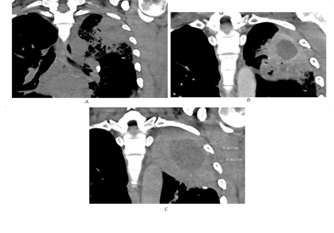 Figure 2: The LUL opacity appears more consolidative with interval development of central fluid attenuation region with relatively thick enhancing wall measures 2.9x2.7 cm, which increases to 4.7x4.5 cm (A= 10 days after admission, B=20 days after admission, C=30 days after admission).