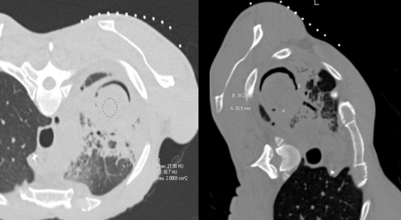 Figure 3: CT chest prone (right), Lateral (left) for attempt to drain the prior noted fluid attenuation. The current CT revealed an intra-cavitary lesion (measures 3.9x3.4 cm) with air crescent sign that move with patient movement consistent with fungus ball and drainage was cancelled at this time.