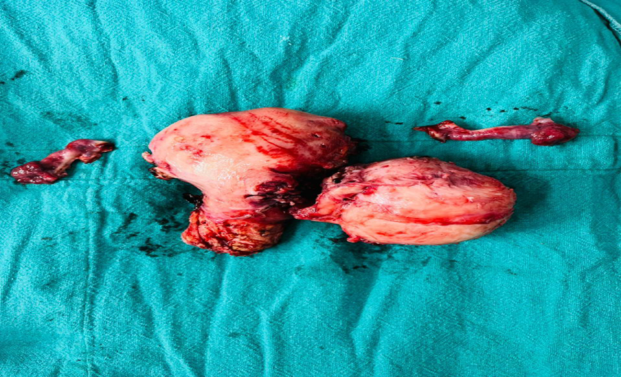 Figure 3: Final specimen with uterus, tubes and myoma which is almost the same size as the uterus.