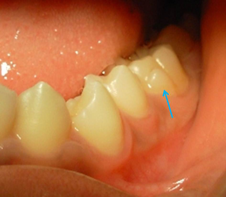 Figure 2: Photograph Showing Appearance of Protoconidal Cingulum/Protostylid as Seen from Buccal View (Blue Arrow). Protostylid was Categorized as Grade 5 Based on Hanihara’s Classification System.
