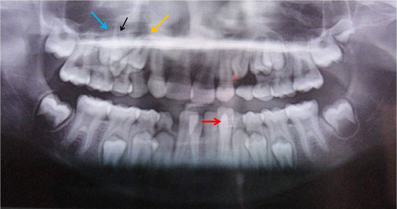 Figure 1: Orthopantomograph Showing Talon Cusp (Red Arrow) in Permanent Mandibular Left Lateral Incisor, Tooth Transposition in Relation to Permanent Maxillary Right Canine (Black Arrow) with Right First Premolar (Yellow Arrow) and Taurodontism in Permanent Maxillary and Mandibular First Molars. Maxillary Right Canine Tooth Bud (Black Arrow) is Located between First (Yellow Arrow) and Second Premolars (Blue Arrow).