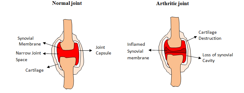 Figure 3: Comparing the joints of individuals with normal and rheumatoid arthritis.