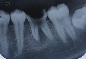 Figure 3: Permanent mandibular right first molar showing Rhyzomicroly. Root length can be compared with adjacent premolar and second molar.