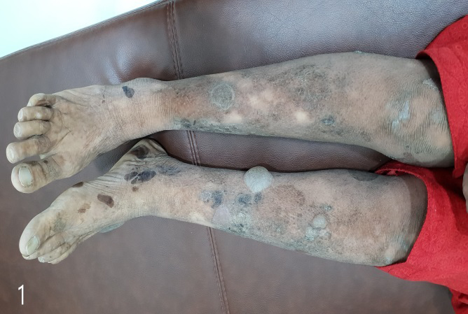Figure 1: Multiple generalised bullae over the legs with crusted erosions and mild scarring.
