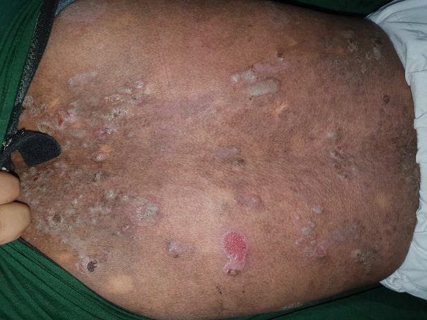 Figure 2: Linear bullae and some showing angulated outline.