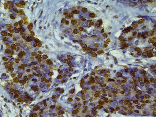 Figure 16: IHC ER: Section shows intense diffuse positivity of tumour cells. Score 3+. IHC ER X 40 X.