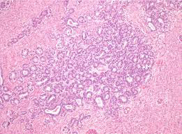 Figure 1: Carcinosarcoma of uterine cervix composed of an amalgamation of epithelial glandular component layered by columnar epithelium with significant cellular and nuclear atypia surrounded by sarcoma-like, spindle shaped cellular component along with few mitotic (Figure 1).