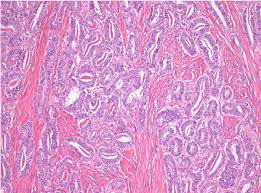 Figure 2: Carcinosarcoma of uterine cervix comprised of commingled epithelial glandular component with prominent cellular and nuclear atypia within lining columnar epithelium surrounded by sarcoma-liked, spindle shaped cellular component with focal skeletal muscle differentiation. Foci of haemorrhage and few mitotic Figure 2 seen.