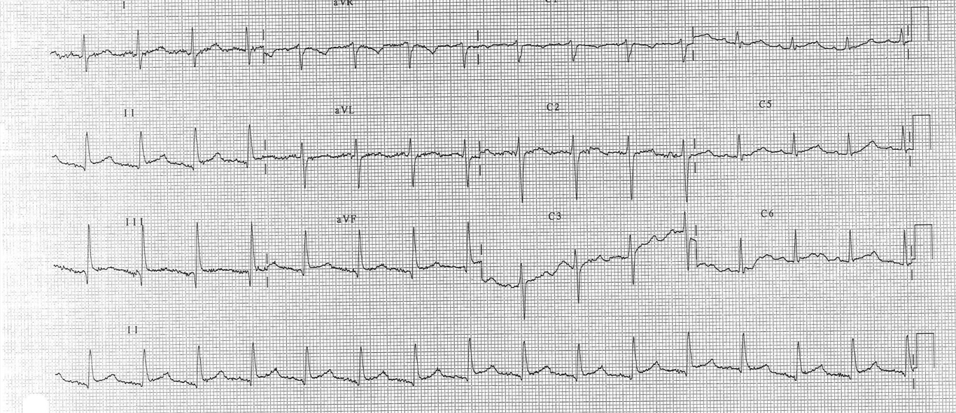 Figure 1: ST elevation.