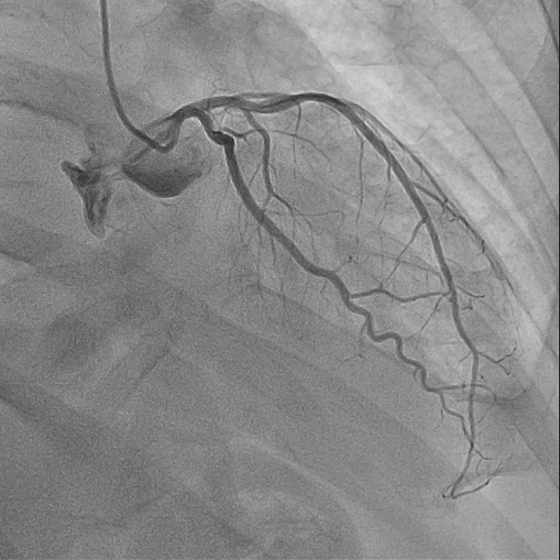 Figure 2: Intact coronary arteries on the left coronary artery.