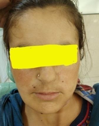 Figure 1: Frontal bossing and multiple oral nevi.
