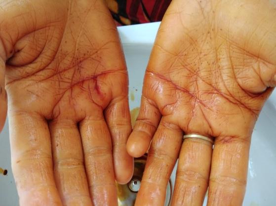 Figure 2: Multiple Palmar. An Intra oral examination revealed carious 36, vestibular tenderness wrt 36 37 38 and on application of pressure with finger, white discharge of fluid was seen in this region. An Orthopantomogram (OPG) of the patient showed multiple cysts in both maxilla and mandible Figure 3.