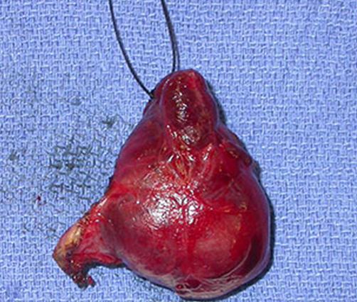 Figure 2: Surgical specimen.