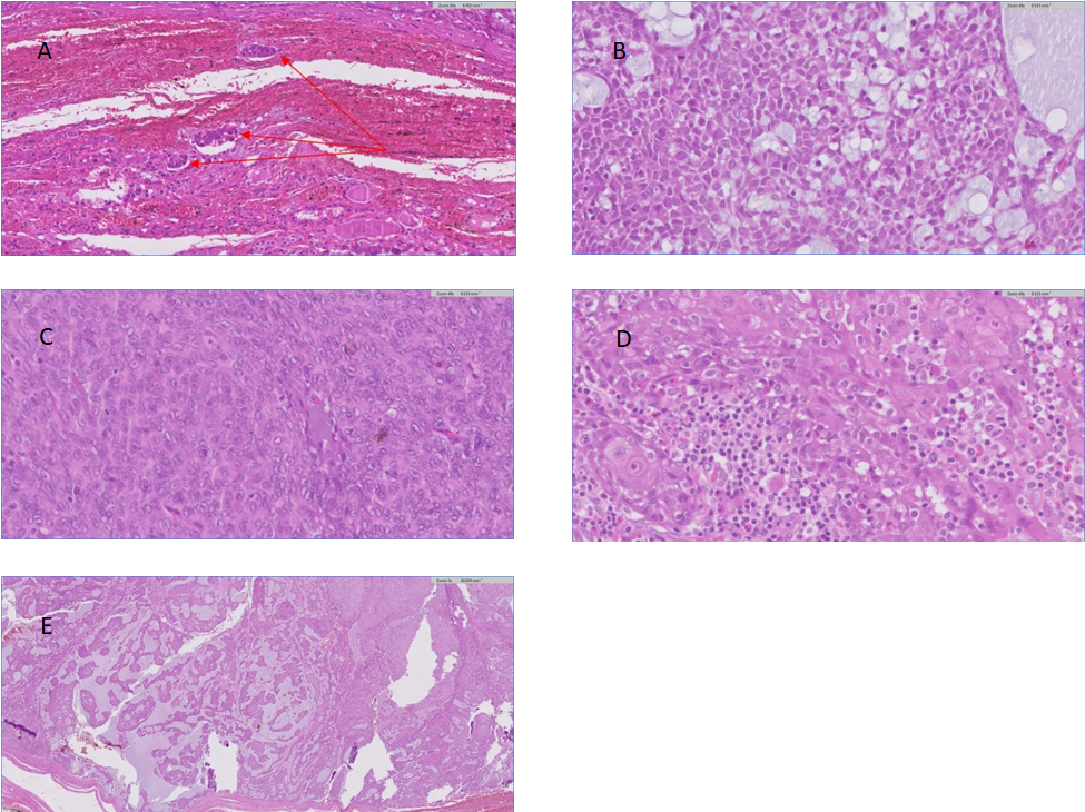 Figure 3: Histological findings. A: Lympho-vascular invasion, B: Vacuolated cells are located within epidermoid cells, C: Mitoses are frequently identified, D: Large irregular nests or solid sheets of tumor cells with prominent nucleoli and intracellular keratinization, E: large irregular nests of epidermoid cell containing glandular spaces with mucin.