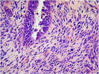 Figure 2: Uterine Adenosarcoma delineating sheets of spherical to ovoid tumour cells incorporated with moderate, pale cytoplasm, vesicular nuclei and prominent nucleoli encompassed within an oedematous stroma. Neoplastic sarcoma cells appear superimposed by benign glandular epithelium. Few mitotic figures may be discerned [7].