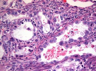 Figure 1: Clear cell adenocarcinoma demonstrating glandular articulations layered by hobnail cells and clear cells pervaded with clear cytoplasm, hyaline globules, nuclear atypia and elevated nucleocytoplasmic ratio. Few mitotic figures are seen. Intervening stroma is fibrotic [6].