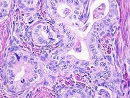 Figure 2: Minimal deviation adenocarcinoma enunciating infiltrative glandular articulations lined by tall, columnar, mucus secreting epithelium pervaded with eosinophilic cytoplasm, hyperchromatic, pleomorphic basal nuclei, vesicular chromatin and prominent nucleoli. Stromal desmoplastic reaction or mitotic figures are minimal.