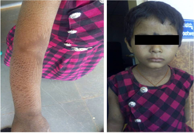 Figure 1: Shows ichthyosis and Erythrokeratoderma.
