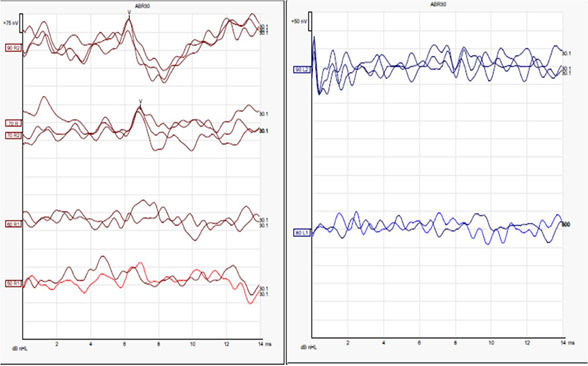 Figure 2: Auditory Brainstem response waveform using click and tone burst stimuli in right ear (represented in red) and left ear (represented in blue).