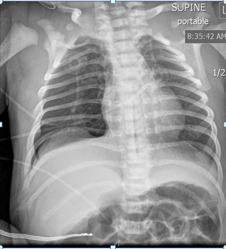 Figure 3: Follow-up chest x-ray on day 1 showed improvement in right pneumothorax.
