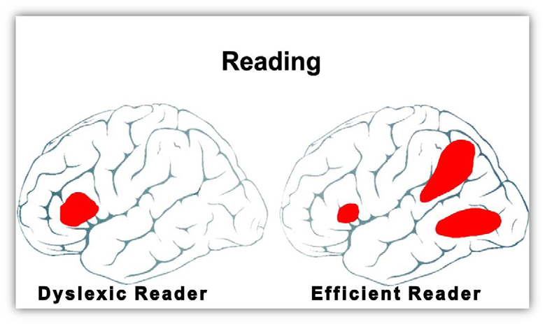 Figure 1: Dyslexic Reader and Efficient Reader.