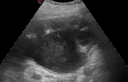 Figure 2: Abdominal ultrasound before (A) and after (B) antibacterial treatment, left kidney. Abdominal computed tomography (CT) was performed (figure 3): Native CT – left-sided hydronephrosis, vaginal pessary. On contrast-enhanced CT - the left kidney is significantly enlarged in size, with marked dilation of the renal pelvis and calyces, no excretion of contrast media