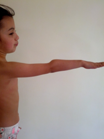 Figure 1: Deformity of the elbow joint in a patient with anterior dislocation of the radial head.