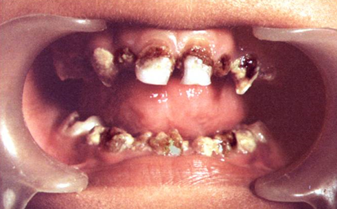 Figure 4: Intraoral photograph showing Amelogenesis Imperfecta, poor oral hygiene, mild marginal gingivitis.