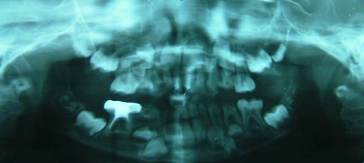 Figure 6: Orthopantomograph radiograph of the child.