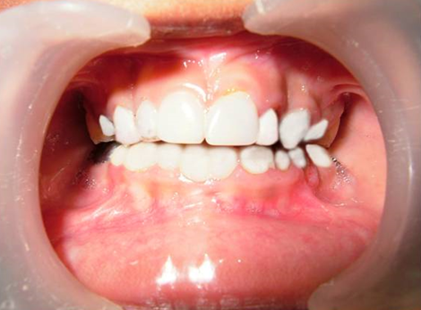Figure 7: Intraoral photograph showing full mouth rehabilitation of the patient.