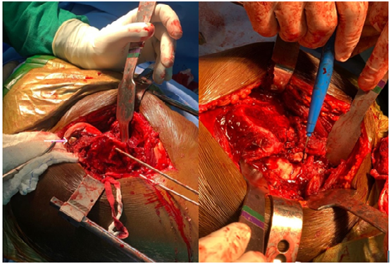 Figure 1: 3D-CT of the gunshot wound showing the bullet and the head and femoral fractures.