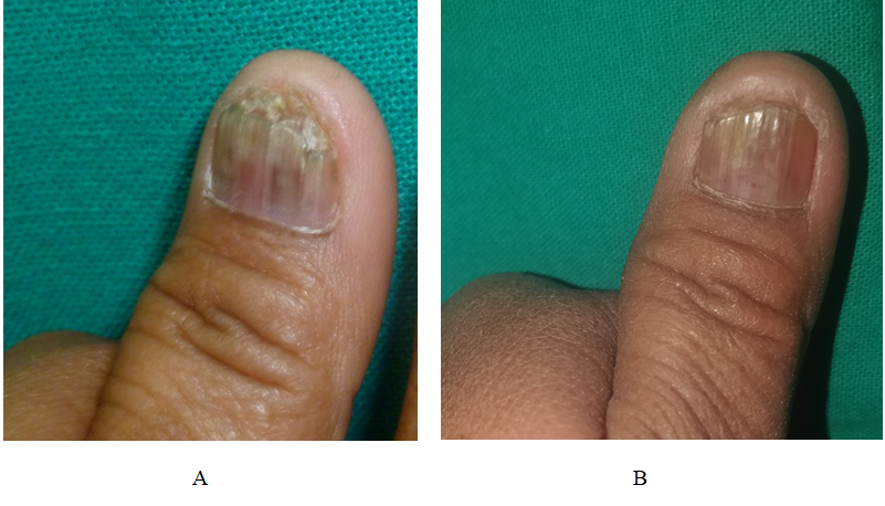 Figure 1: (A) Recalcitrant onychomycosis prior to laser sessions; (B) Reduction in nail involvement after 8 laser sessions.