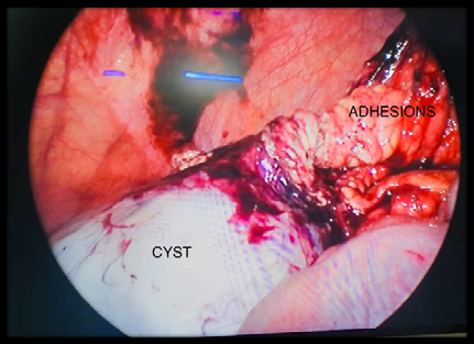 Figure 1: Mesentric Cyst with Adhesions.