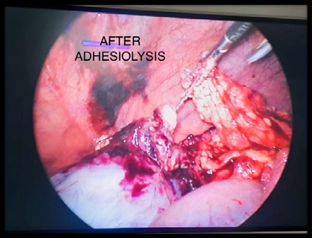 Figure 3: After Adhesiolysis.