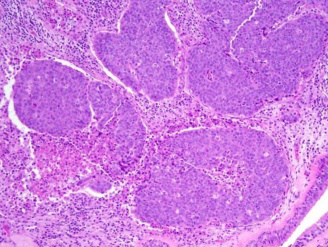 Figure 1: NUT pulmonary carcinoma demonstrating lobules of primitive, monotonous, small round cells permeated with minimal cytoplasm with cytoplasmic clearing, enlarged nuclei and prominent nucleoli. Foci of abrupt keratinization are seen. Surrounding stroma is preponderantly infiltrated by neutrophils [5].