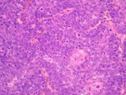 Figure 2: NUT pulmonary carcinoma delineating aggregates of primitive, monotonous, small round cells pervaded with minimal cytoplasm with cytoplasmic clearing, enlarged nuclei and prominent nucleoli. Foci of abrupt keratinization are seen. Circumscribing stroma is infiltrated by prominent neutrophilic infiltrate [6].